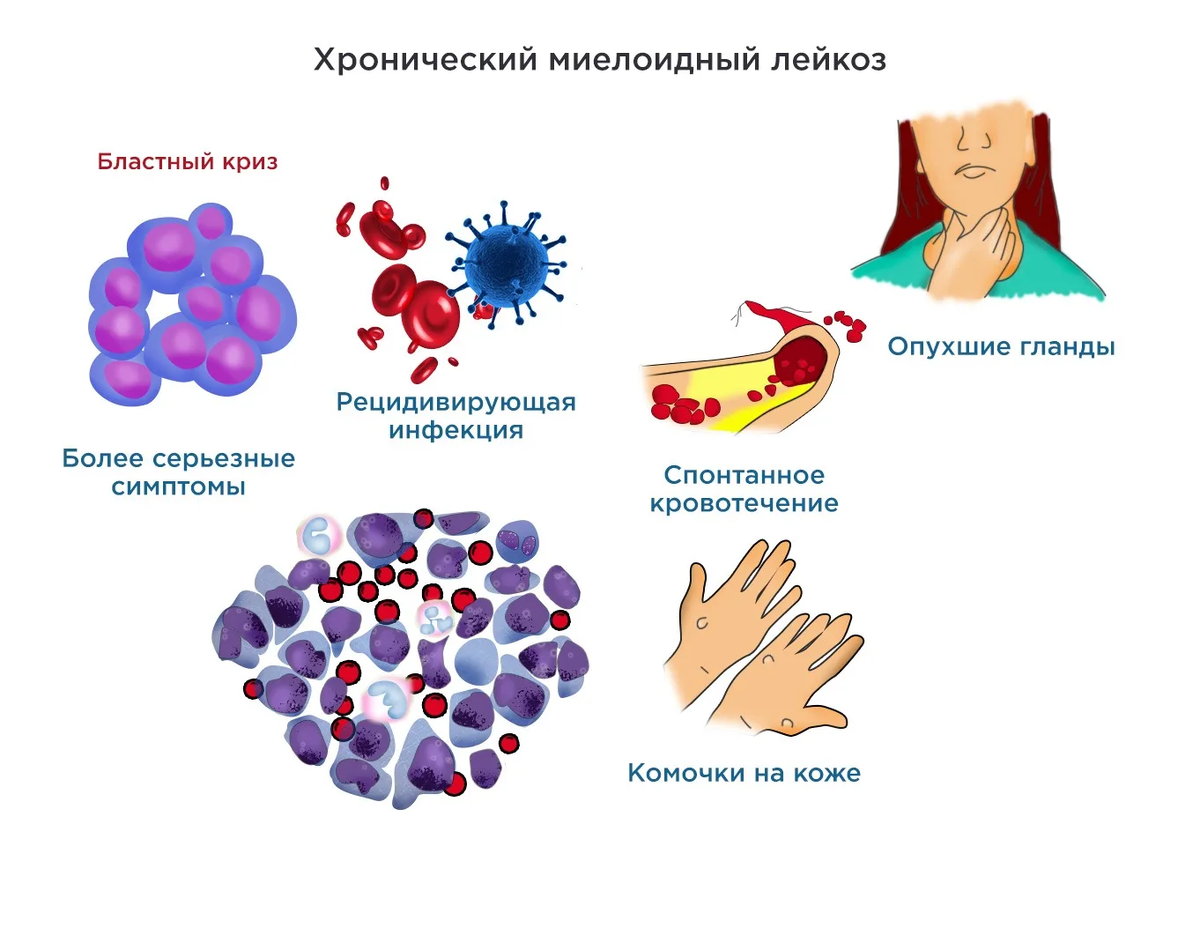Как выглядит рак крови