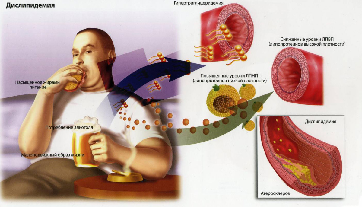 Атеросклероз холестерин. Гиперхолестеринемия. Дислипидемия.