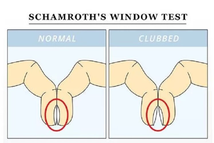 ТЕСТ ШАМРОТА, УГОЛ ЛОВИБОНДА | Эпонимы и Мы | Дзен