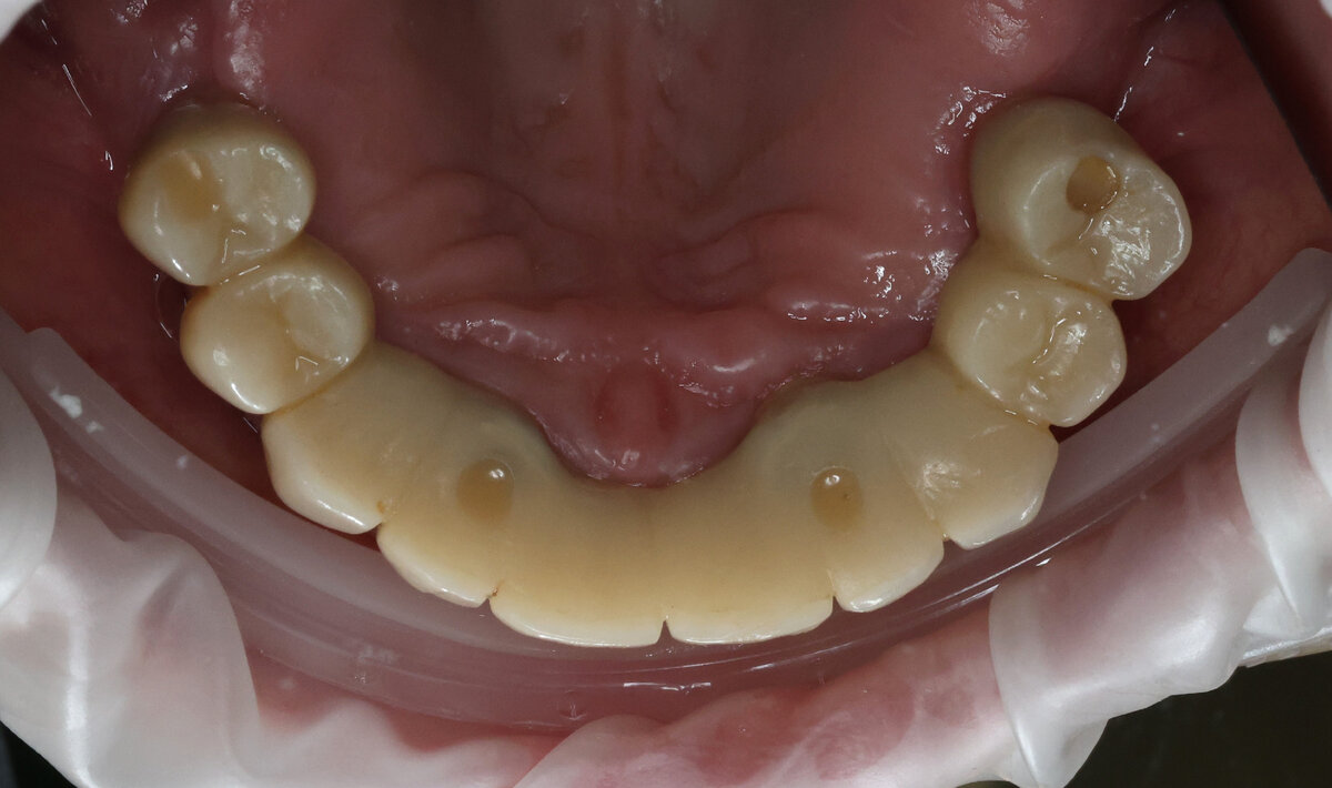 Провалы, дырки, сколы и остатки еды - чего ожидать от десны и от временного  протеза на 4-х имплантатах через 4 месяца | Parodoctor | Дзен