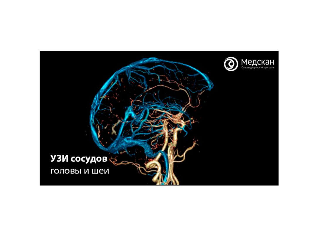 УЗИ сосудов головы и шеи | Медицинские центры 