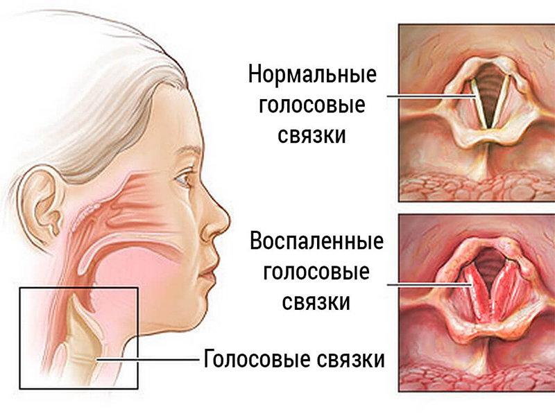 Как потерять голос за минуту