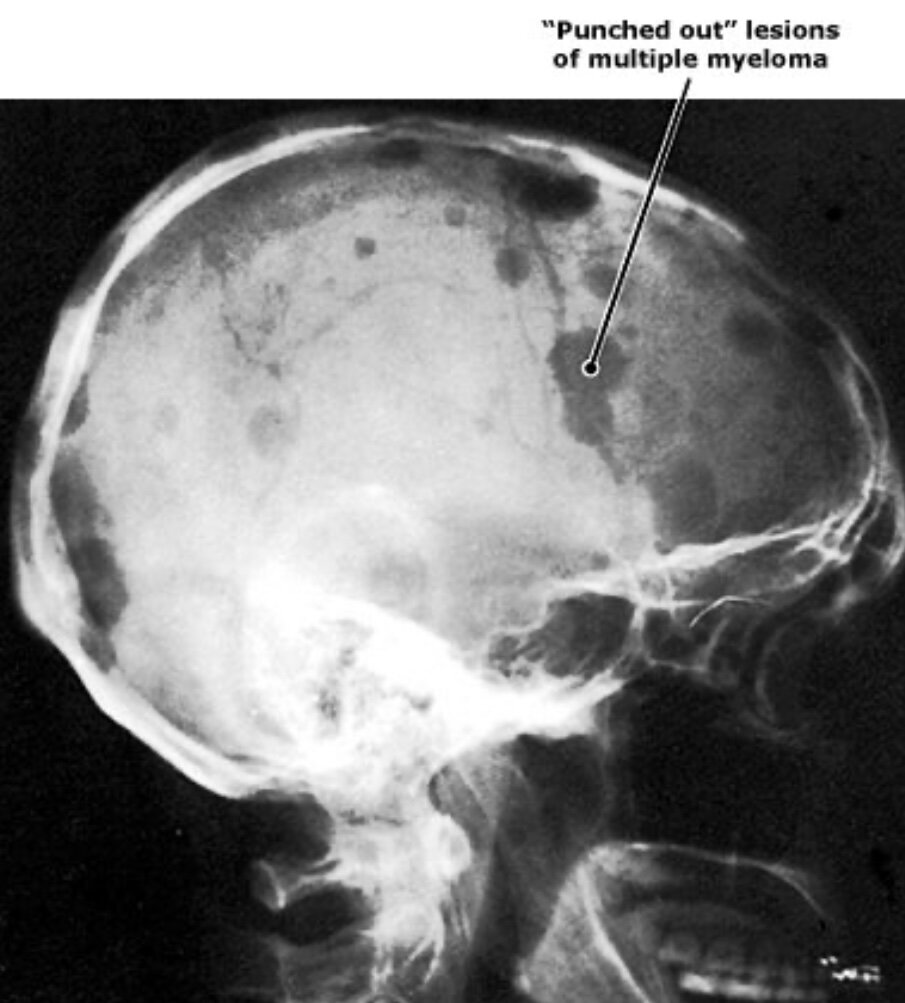 На этой рентгенограмме черепа пациента с множественной миеломой "выбитые" литические поражения являются результатом разрушения  плазматических клеток.