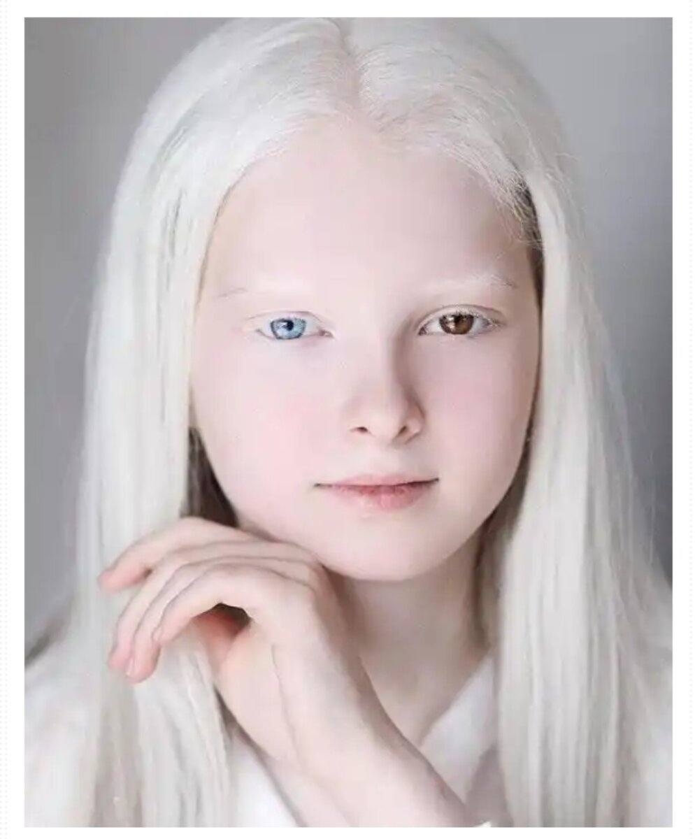 Вы когда-нибудь видели раньше человека с альбинизмом? Это генетическое заболевание серьезно снижает уровень пигмента, отвечающего за защиту нас от солнца, называемого меланином. Однако у этой девушки также есть гетерохромия, из-за которой у нее один глаз ледяного голубого цвета, а другой — красный. Она действительно прекрасна!