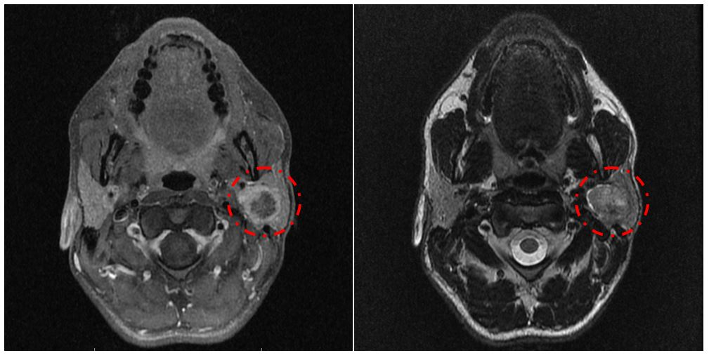 МРТ головного мозга пациента с признаками новообразования околоушной слюнной железы