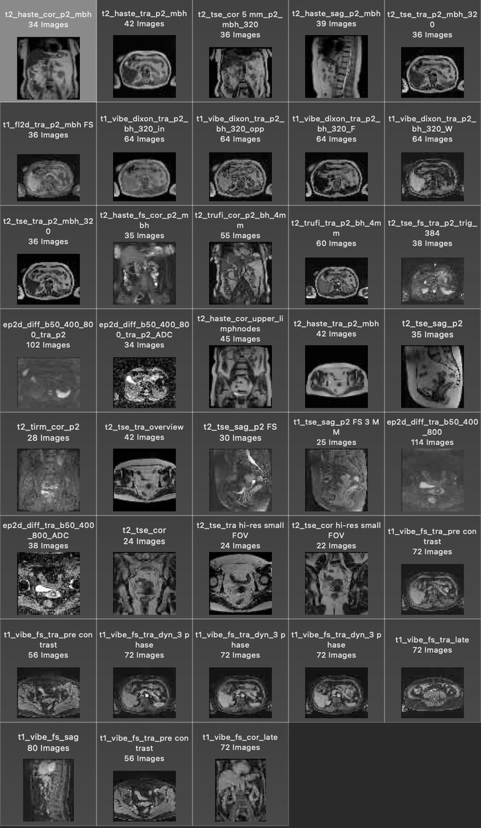 Пример нашего стандартного набора серий томограмм в одном МРТ исследовании бр. полости и малого таза с контрастом (38 серий по нескольку десятков изображений в каждой, всего 1932 изображения в одном исследовании). 