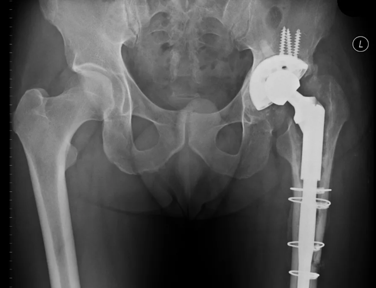 Тазобедренный сустав операция показать. Эндопротезирование тазобедренного сустава рентген. Рентген снимок тазобедренного сустава после эндопротезирования. Коксартроз эндопротезирование тазобедренного сустава. Снимки после эндопротезирования тазобедренного сустава.