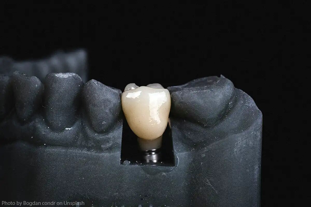 Достоинство металлокерамических коронок – сочетание прочности и эстетизма