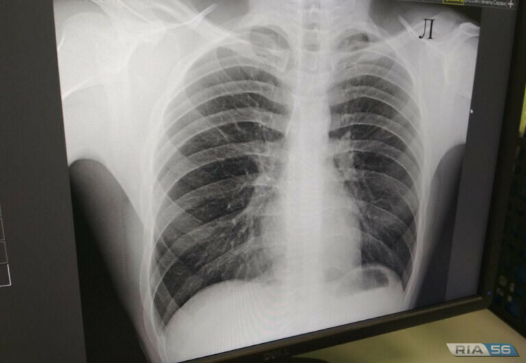    Оренбургские врачи напоминают, что курение увеличивает статистику онкозаболеваний Белов Михаил Александрович