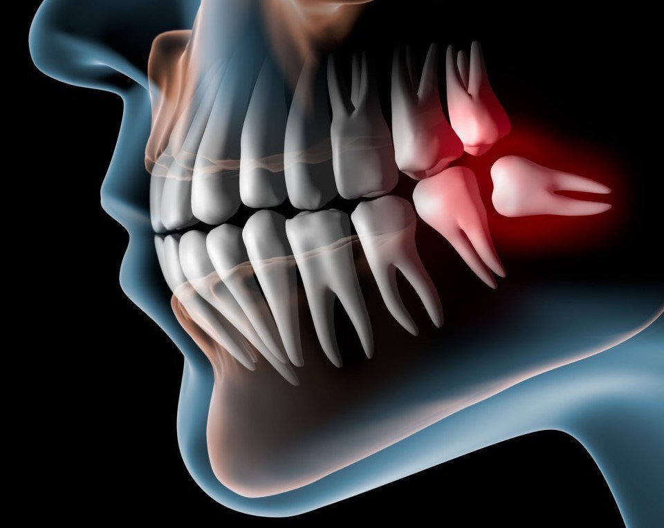 перикоронарит 