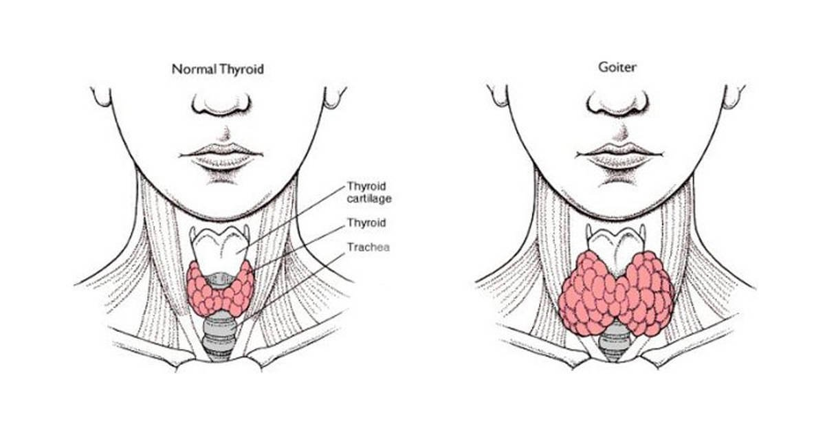 Зоб щитовидной железы 3 степени. Заболевания щитовидной железы схема. Узловой эндемический зоб. Узловой зоб щитовидной железы.
