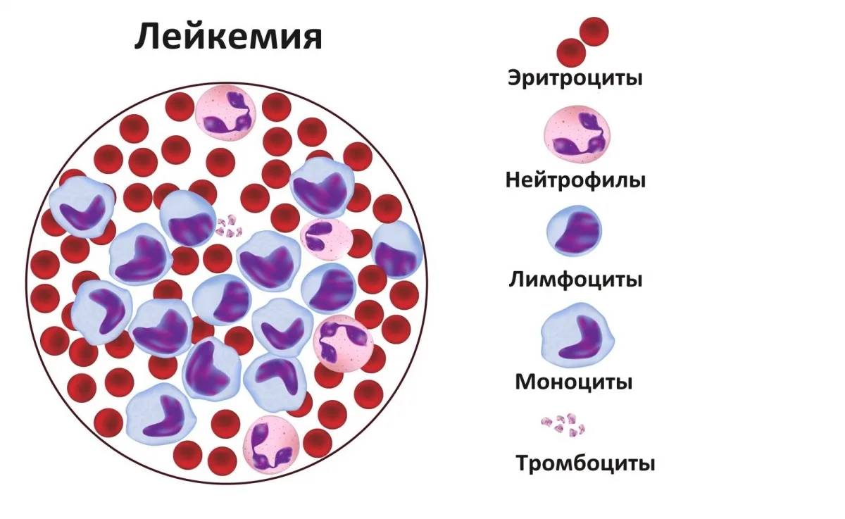 Как выглядит рак крови