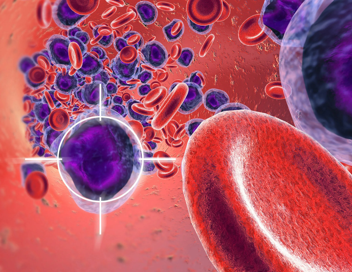 Лейкоз клетки крови. Злокачественный лейкоз