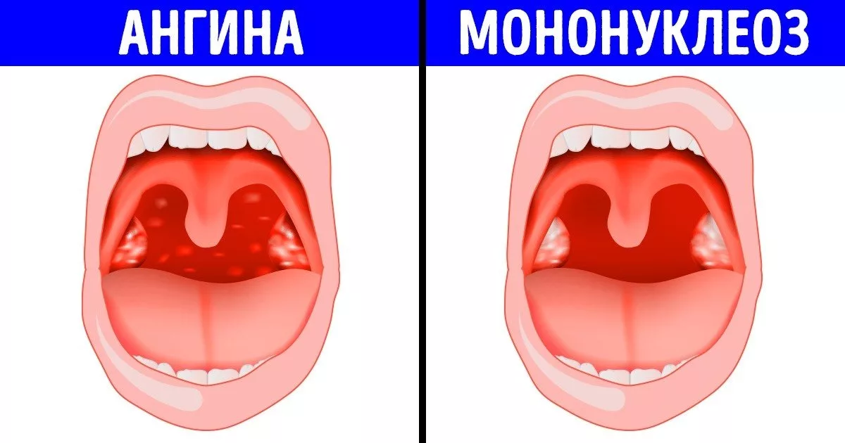 Лечение инфекционного мононуклеоза у детей и взрослых