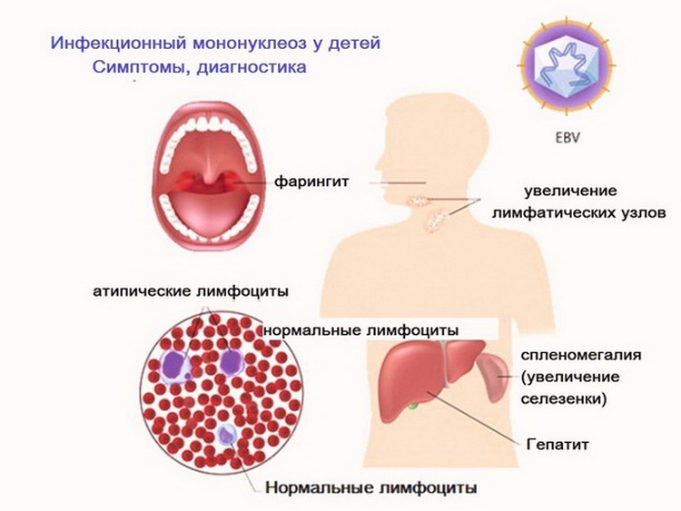 Перенесли мононуклеоз