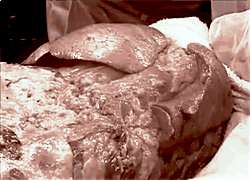 Лёгкие человека.