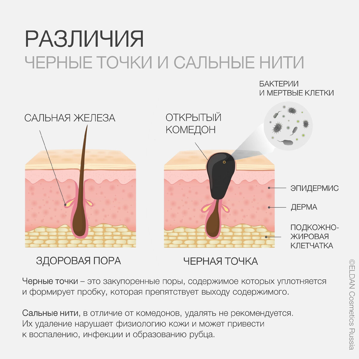 Черный точки и сальные нити | В чем разница? | ELDAN Cosmetics Russia ...