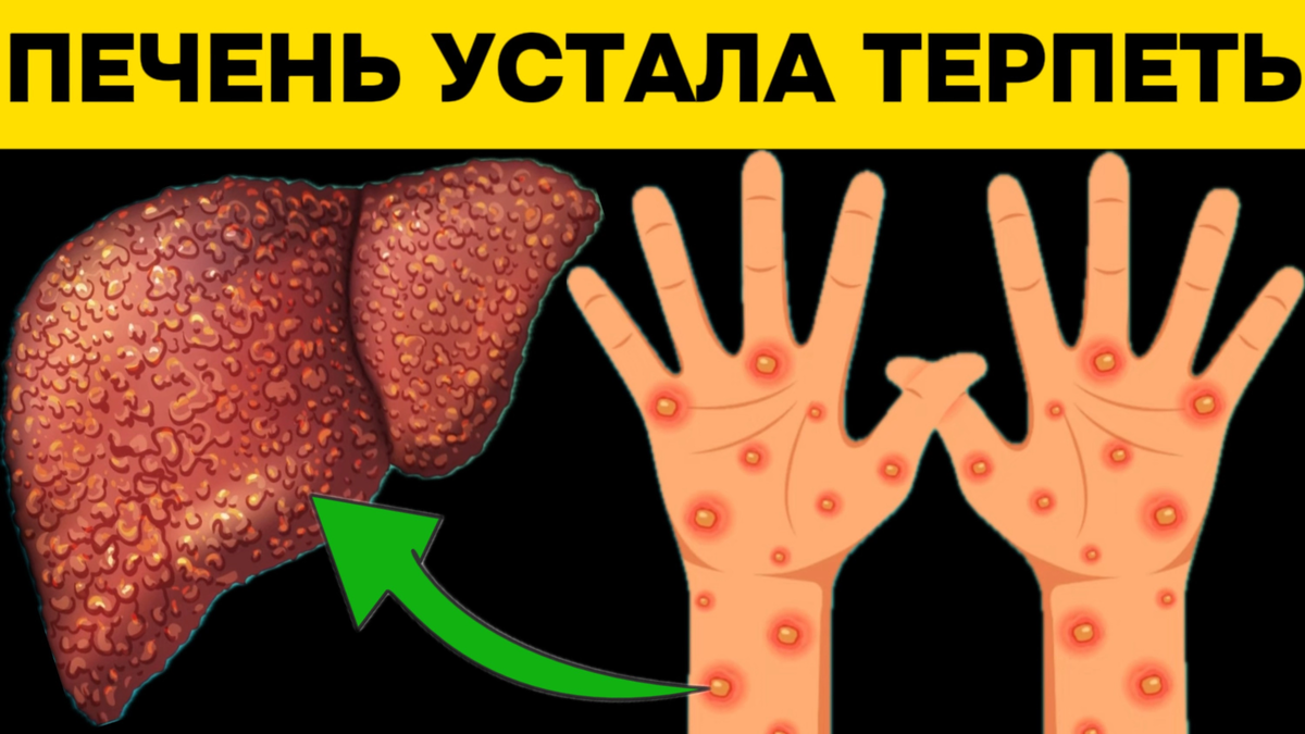 Наша печень в опасности? 12 Ранних признаков цирроза печени | Игорь  Ботоговский | Дзен