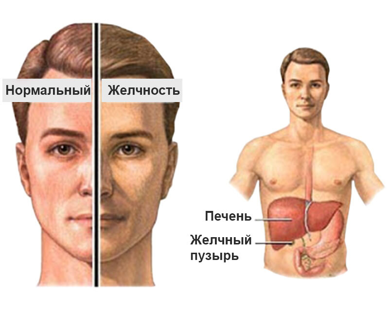 От чего может пожелтеть кожа. Интермиттирующая желтуха.