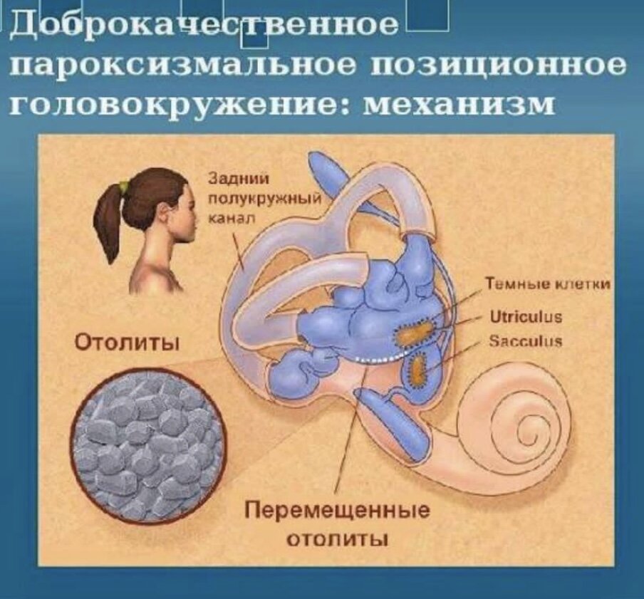 Позиционное головокружение симптомы. Доброкачественное пароксизмальное головокружение. Доброкачественное позиционное головокружение. Пароксизмальное позиционное головокружение. ДППГ доброкачественное пароксизмальное.