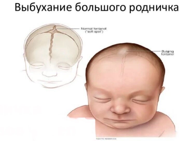 Выбухание родничка