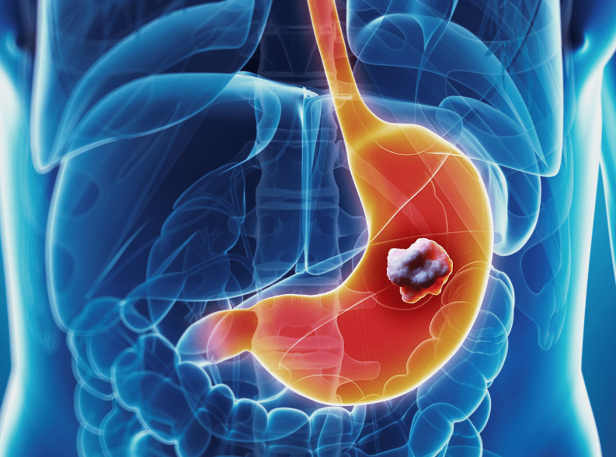Хронический гастрит презентация. Хронический гастрит симптомы. Не работает желудок симптомы. Не работает желудок симптомы. Как вылечить повышенную кислотность желудка.