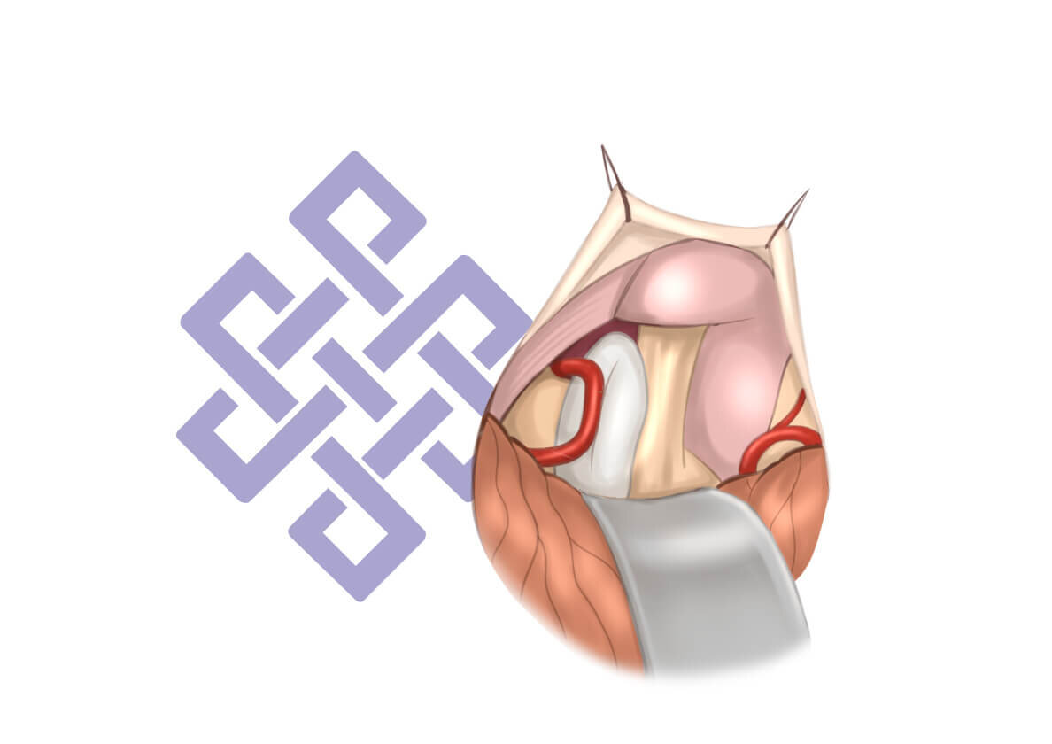 Нейроваскулярный конфликт тройничного нерва 