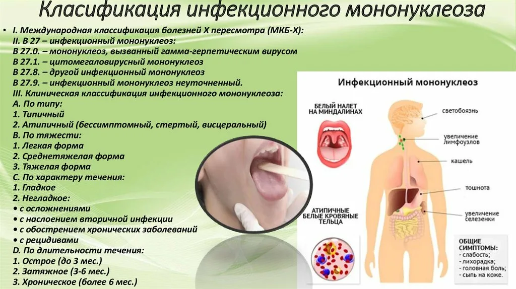 Горло при вирусе эпштейн барра фото Проявления мононуклеоза и способы его лечения: что важно понимать родителям О де