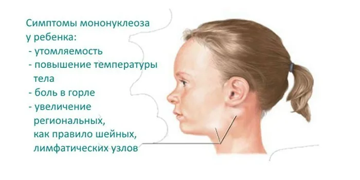 Увеличенные лимфоузлы температура 37. Инфекционный мононуклеоз сыпь. Инфекционный мононуклеоз вирус Эпштейна Барра. Мононуклеоз Эпштейн Барра у детей. Инфекционный мононуклеоз лимфатические узлы.