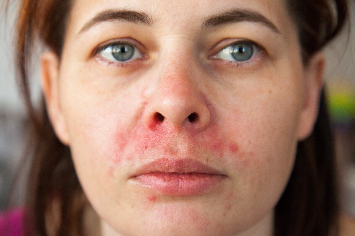 Себорейный дерматит