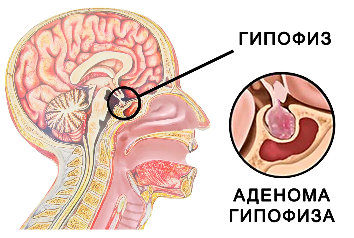 Аденома гипофиза: описание, симптомы, диагностика и лечение | ЛабСтори