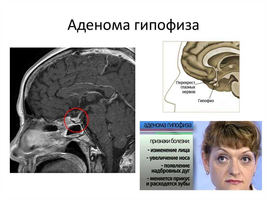 Аденома гипофиз мозга что это такое