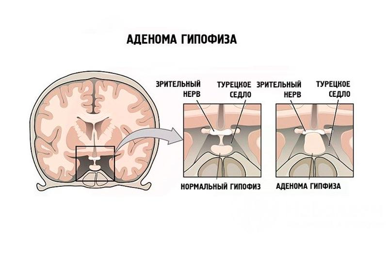 Эндоселлярное образование гипофиза. Аденома передней доли гипофиза. Аденома гипофиза головного мозга что это такое. Микроаденома гипофиза головного мозга 5 мм.