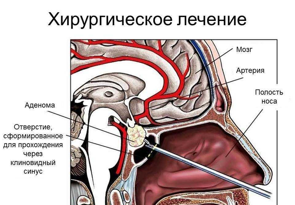 Трансназальная хирургия аденомы гипофиза. Транссфеноидальная аденомэктомия. Опухоль аденома гипофиза. Эндоскопическая эндоназальная транссфеноидальная аденомэктомия.