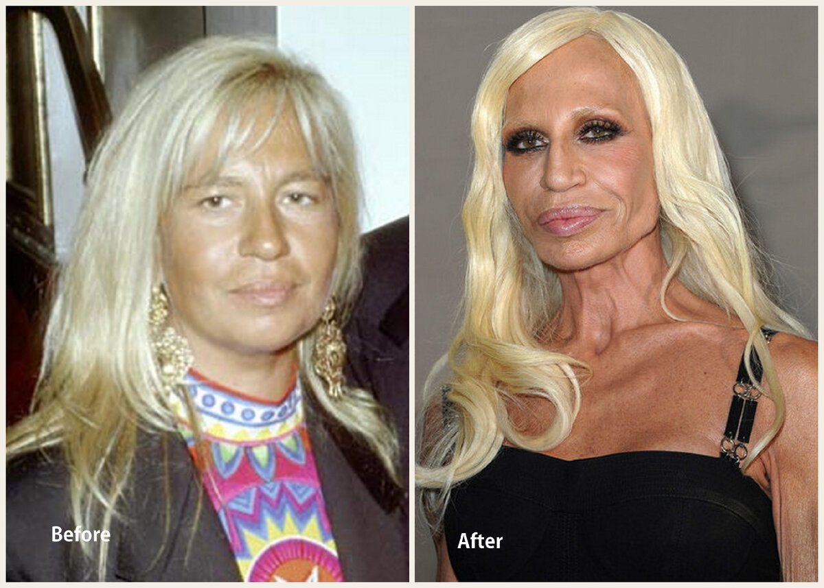 Фото: https://mia-bags.ru/donatella-versace-kak-vygladela-zvezda-do-i-posle-plasticeskih-operacij/