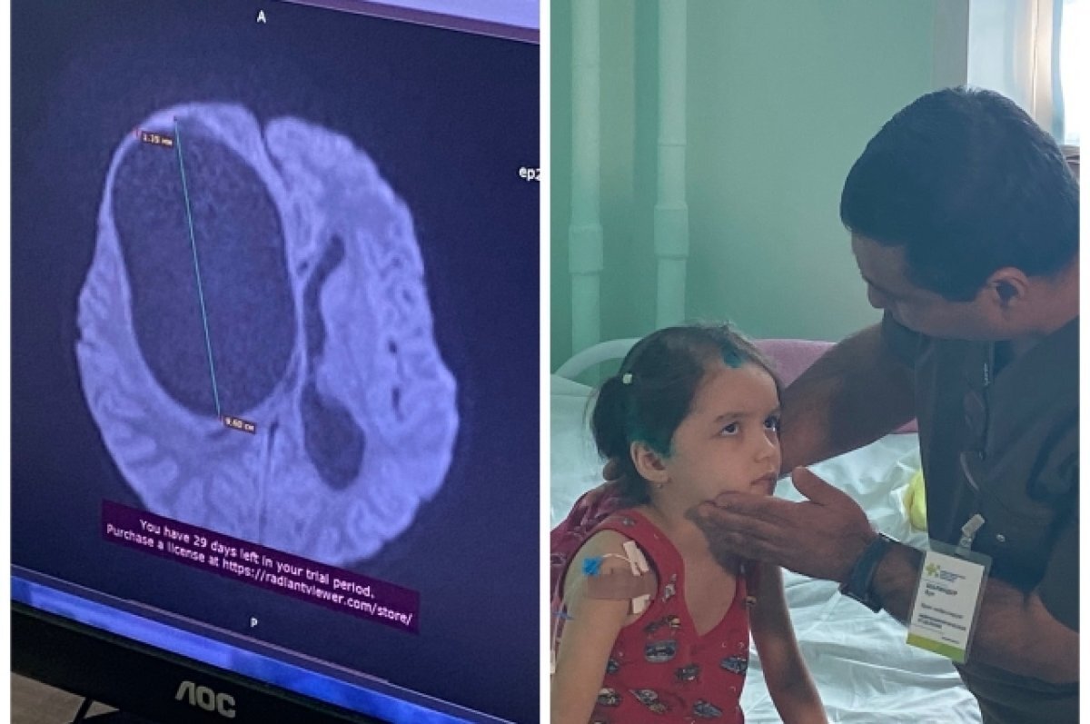    Новосибирские врачи удалили кисту 10 см из головного мозга 5-летней девочки