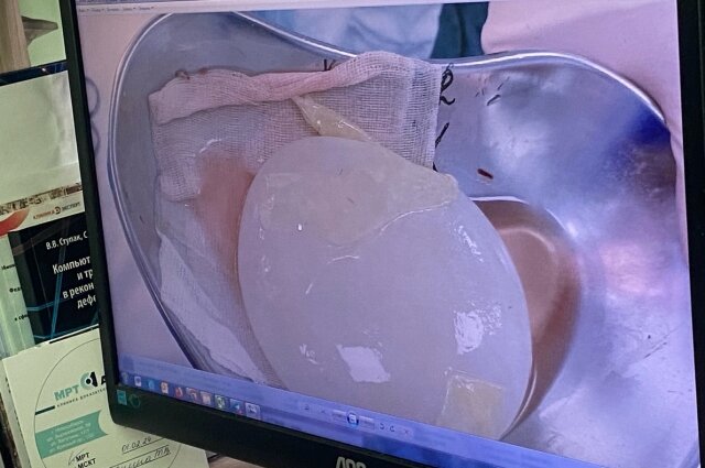    Киста размером 10 сантиметров. Фото: "АиФ-Новосибирск"