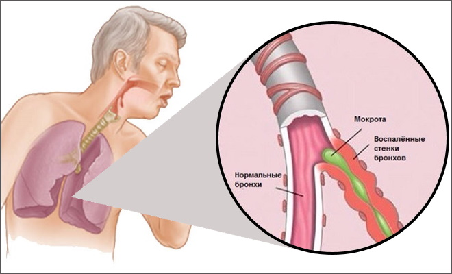 Бронхит, что за болезнь, симптомы, диагностика, лечение