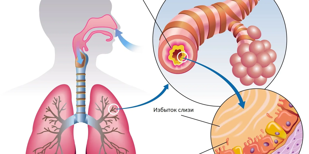 Постоянный кашель, трудно дышать и плохо откашливаюсь – что такое аллергический бронхит?
