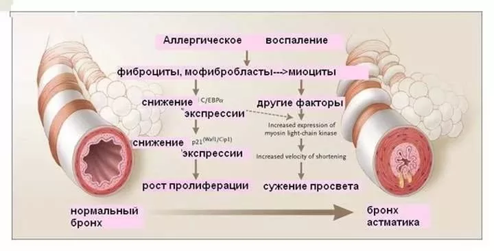 Бронхоспазм как снять быстро препараты Постоянный кашель, трудно дышать и плохо откашливаюсь - что такое аллергический 