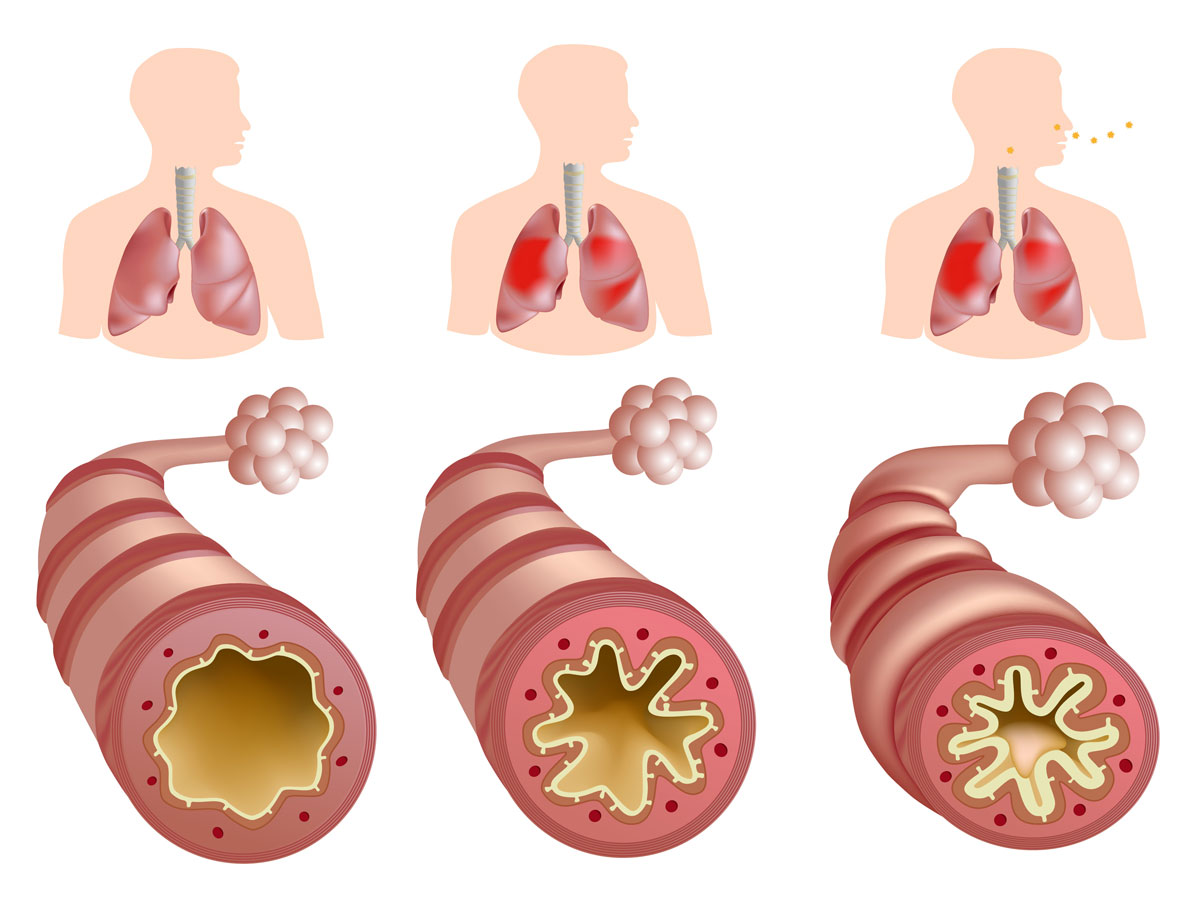 Бронхит - причины, симптомы и лечение острого и хронического бронхита