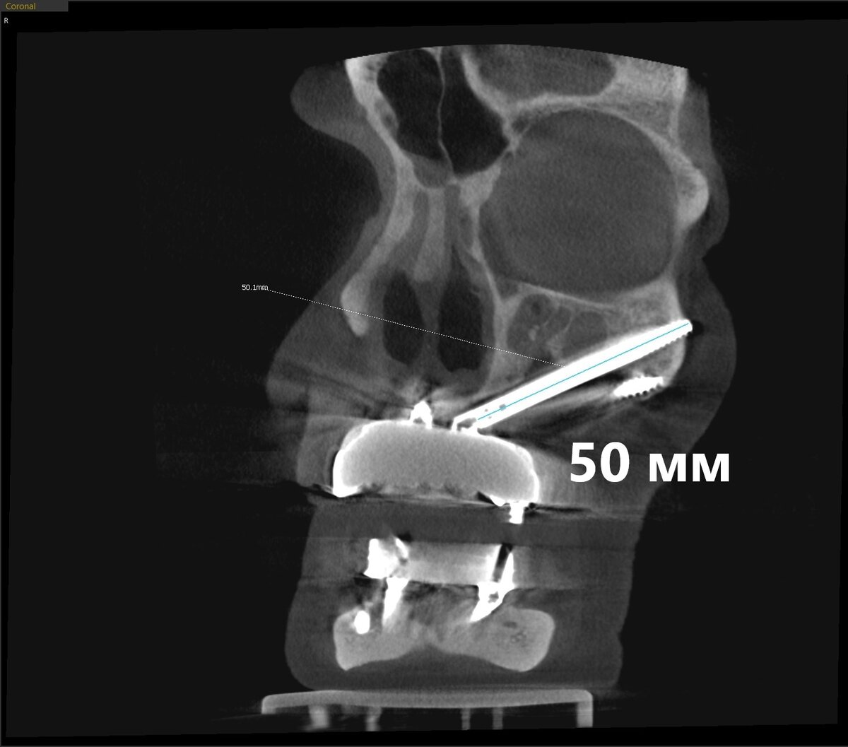 Скуловая имплантация Zygoma 