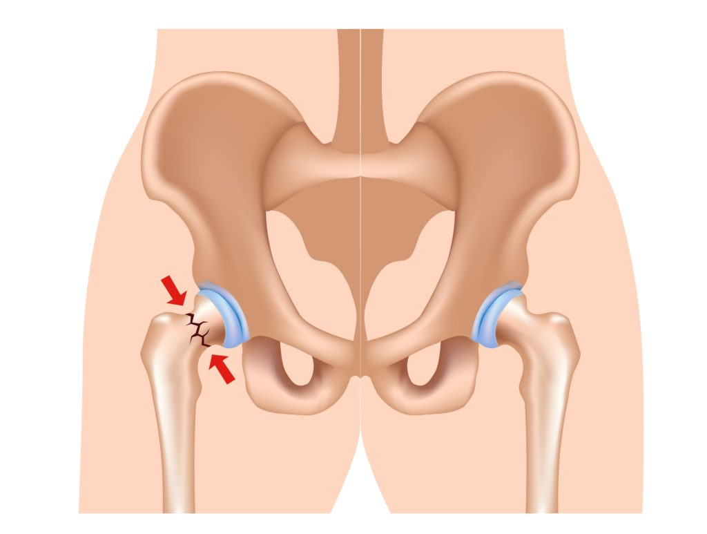 Трещина шейки бедра. Врожденный вывих тазобедренного сустава. Шейка бедра анатомия. Тазобедренный сустав перелом шейки бедра.