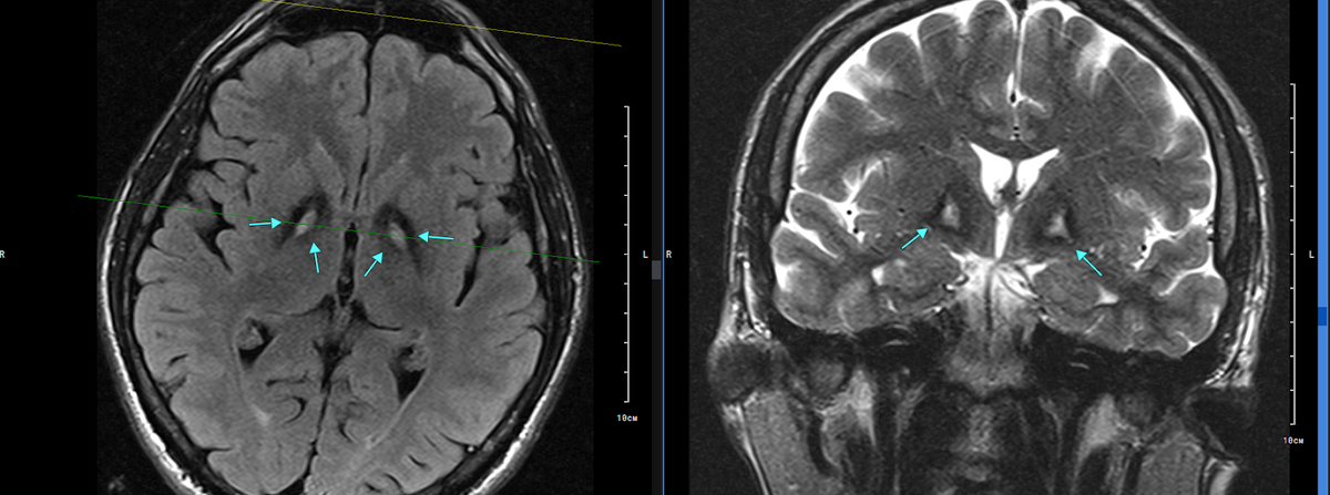 Рис. 1. Слева направо: Т2flair аксиальная плоскость, Т2 корональная плоскость. Стрелками указаны симметричные зоны измененного МР сигнала в области базальных ядер.