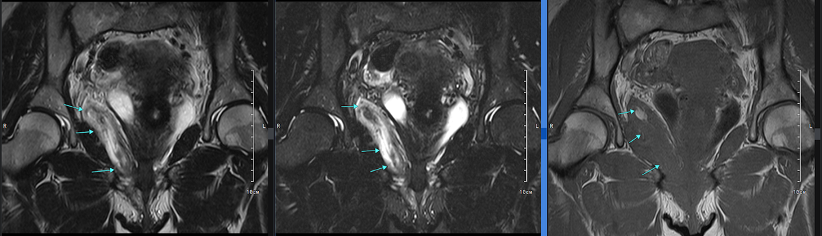 Этиология опухолей патофизиология. Стадии злокачественных новообразований. Виды роста опухолей. Типы опухолевого роста. Патология тканевого роста патофизиология.
