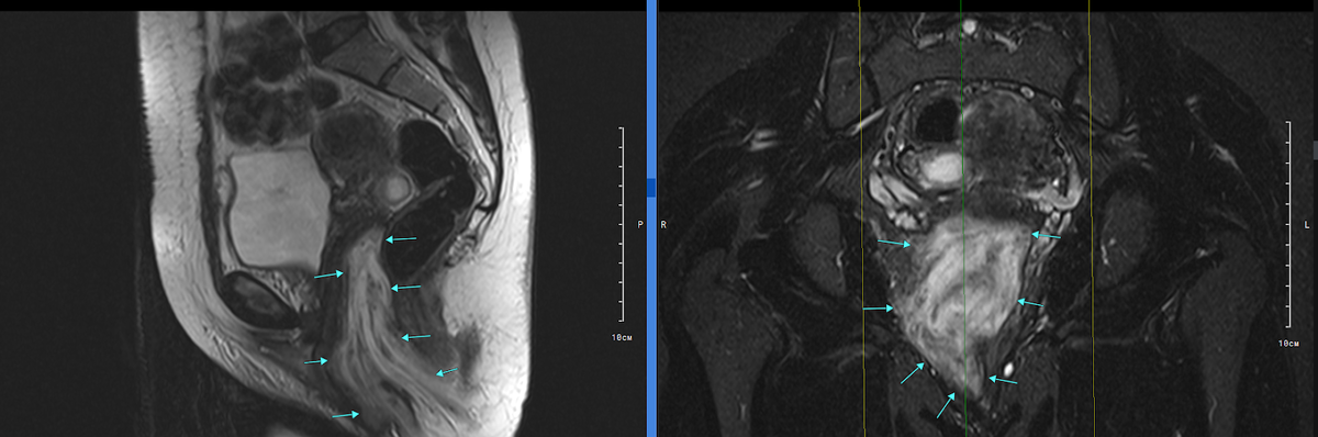 Рис.1. Т2 сагиттальная плоскость и Т2-tirm корональная плоскость (слева направо). Стрелками указано внеорганное объемное образование в области тазового дна с распространением в полость малого таза.