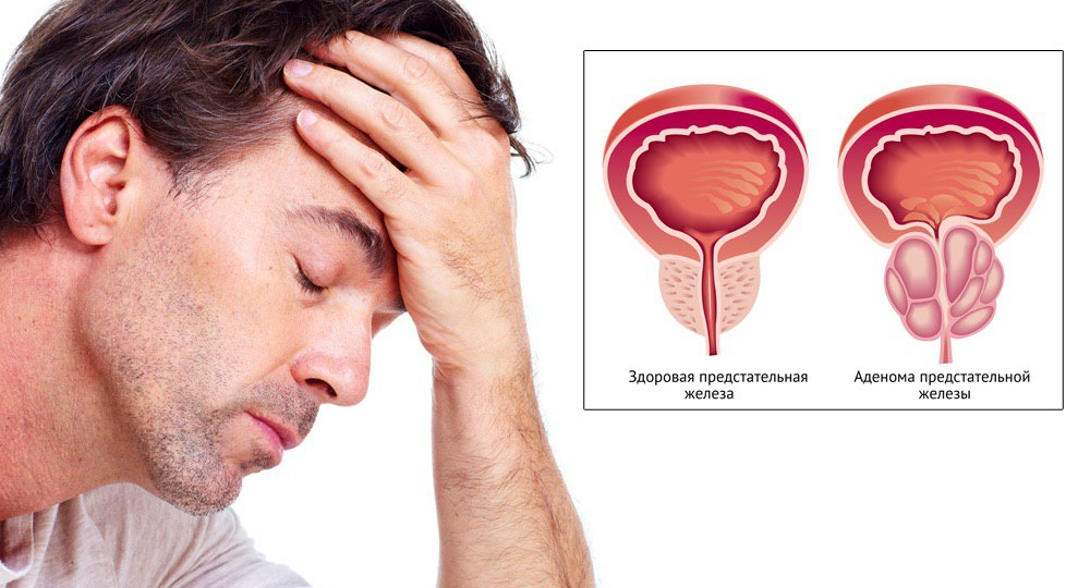 Аденома простаты – это не рак, но важно следить за своим здоровьем: что такое ДГПЖ
