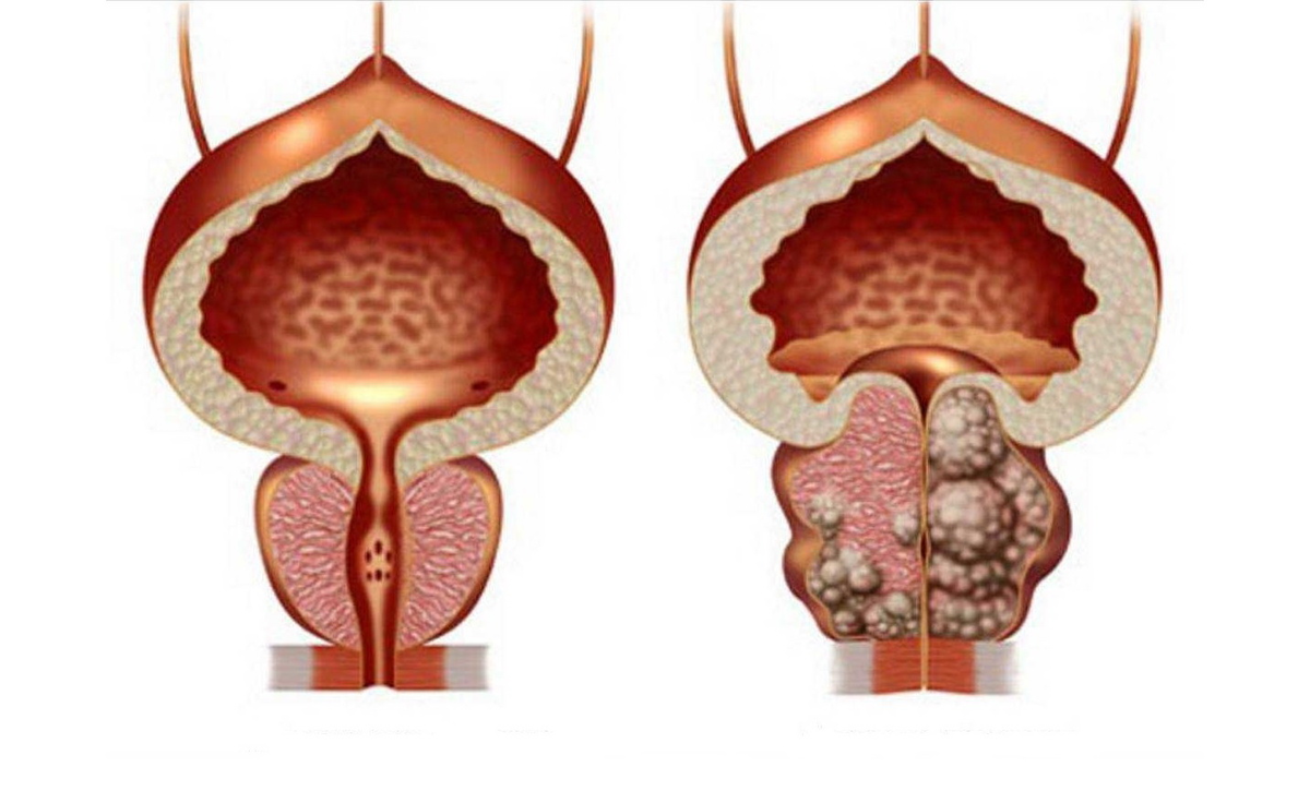 Удаление мочевого пузыря при раке. Аденома предстательной железы (аденома простаты). Доброкачественная гиперплазия (аденома) предстательной железы. Аденома предстательная железа у мужчин.