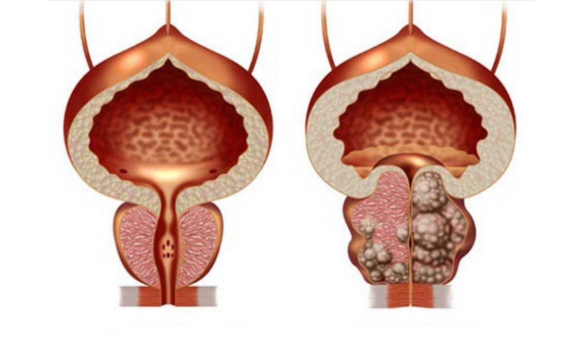 Аденома предстательной железы (аденома простаты). Доброкачественная гиперплазия (аденома) предстательной железы. Аденома предстательная железа у мужчин. Гиперплазия предстательной железы операция