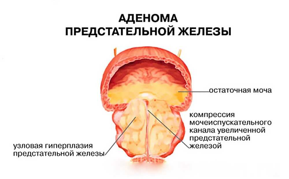 Удаление железы простаты